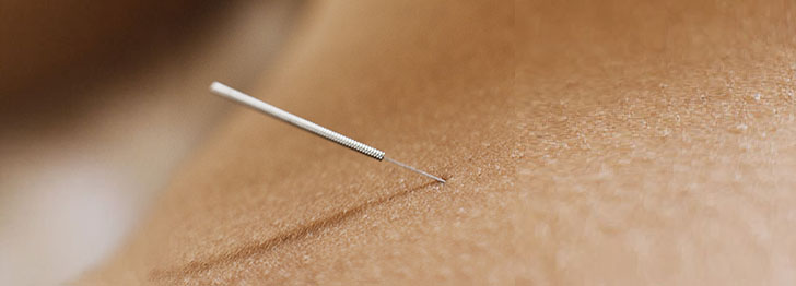 Behandling med akupunktur